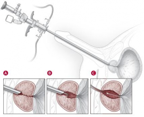 adenoma alla prostata intervento)