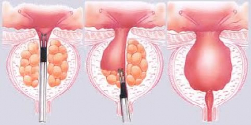 adenoma prostata intervento chirurgico