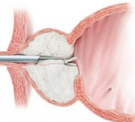adenoma prostata intervento chirurgico