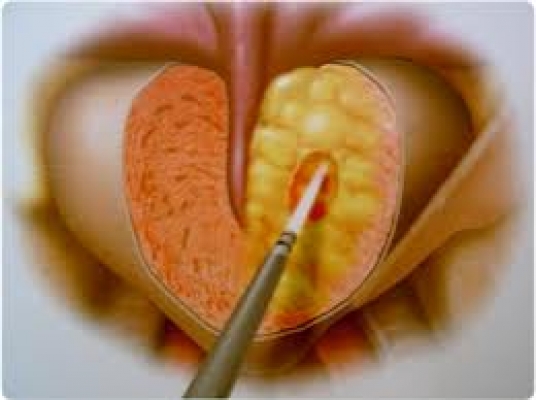 adenoma prostata intervento chirurgico