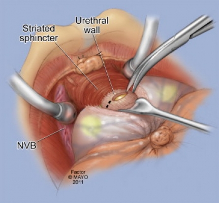 intervento prostata video