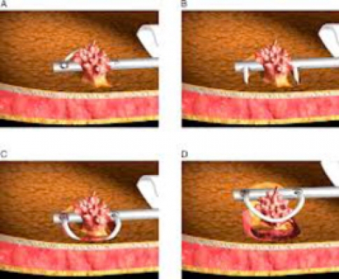 resezione papilloma vescicale