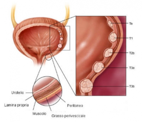 Sangre en la orina (hematuria) - Síntomas y causas - Prostaffect сumpără